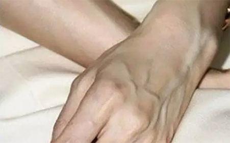 善水藥墨提醒：不可忽視的“青筋暴起”現象