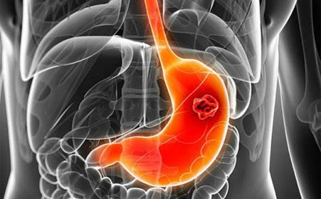 海外醫療，80%的患者檢查確診為胃癌中晚期，十類人需警惕胃癌