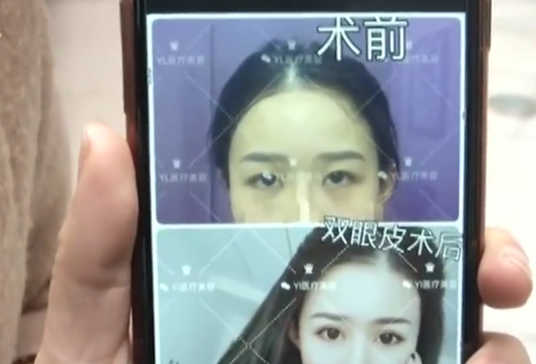 女子花18000割雙眼皮后下垂 醫院：因地球引力