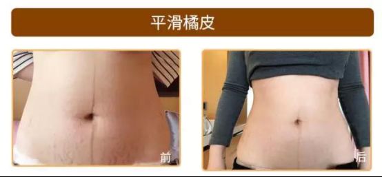 愛博恩醫學護理·引領產婦瘦身新浪潮