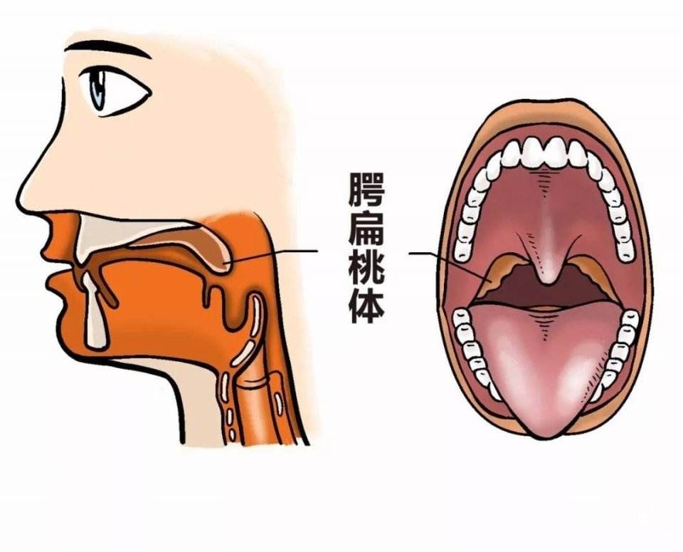 孩子扁桃體老發炎能不能一刀切？