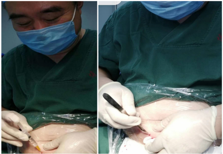 自己給自己做手術！菏澤這位醫院院長是個“狠人”