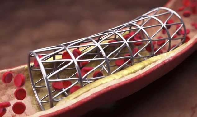 高值醫用耗材治理的重要一步（人民時評）