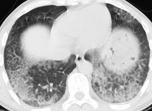 專家：肺部磨玻璃結節不一定等于肺癌