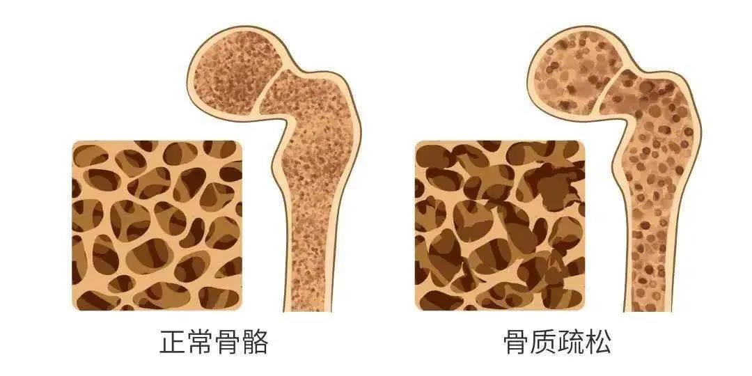 德州市中醫院骨傷科專家為您講解骨質疏松的危害，速來圍觀