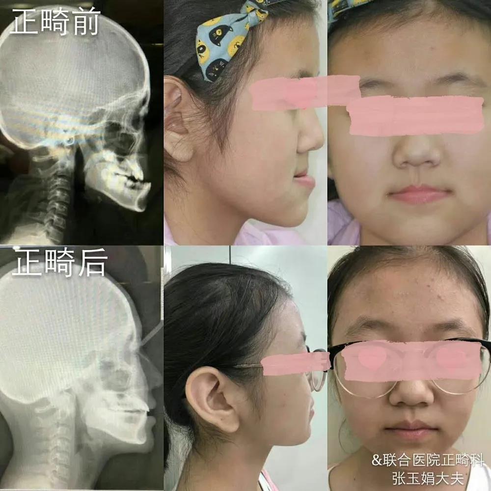 世界口腔正畸健康日 | 腺樣體面容難以自愈 需及早就醫