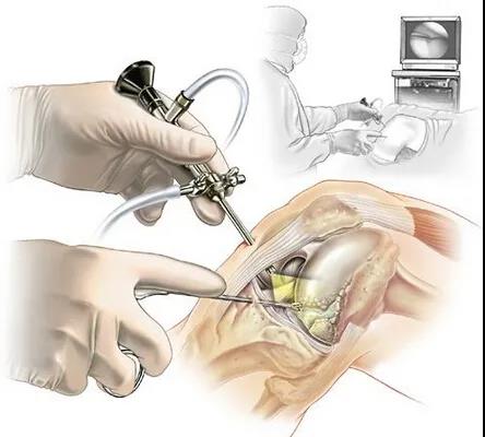 膝關節鏡到底是什么，聽德州市中醫院骨傷科專家告訴您
