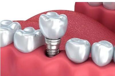 多地醫保局調查費用 種植牙集采加速推進