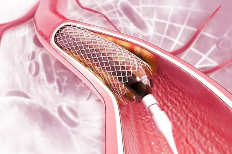 國家組織冠脈支架集采接續采購 首年需求量超180萬個