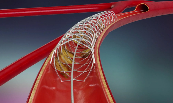 冠脈支架集采接續采購結果出爐 讓患者持續受益