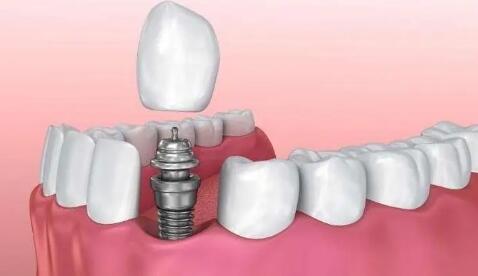 多地種植牙價格調控政策將于4月份實施 業內人士稱市場需求將進一步釋放