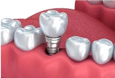 北京口腔種植體系統中選結果公布 4月20日將執行集中帶量采購