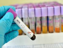 中疾控發布丙型肝炎檢測新規范