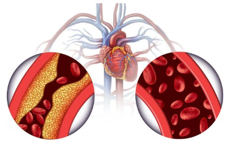 首次發病有年輕化趨勢 我國將建立心腦血管疾病綜合防控體系