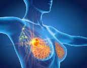 專家：加強中青年醫生人才培養 提升乳腺癌診療水平