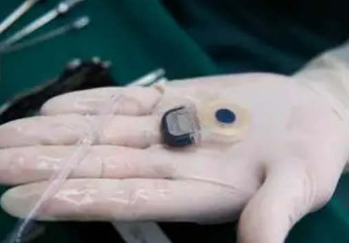 單套價格降幅超75% 人工耳蝸集采落地北京