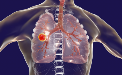 國家疾控局：全國結核病成功治療率保持在90%以上