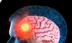 顯效率77.26% 覆蓋328縣 我國基層癲癇防治取得扎實成效