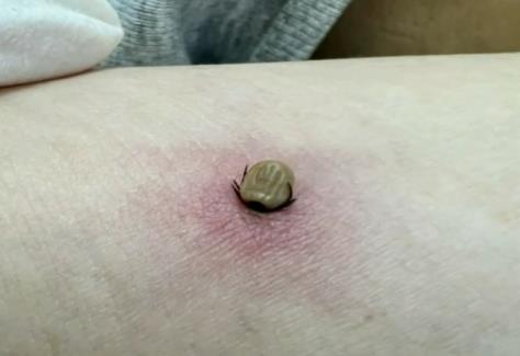 夏季蚊蜱等蟲媒傳染病風險顯著上升 如何防范保安全？90秒快速了解！